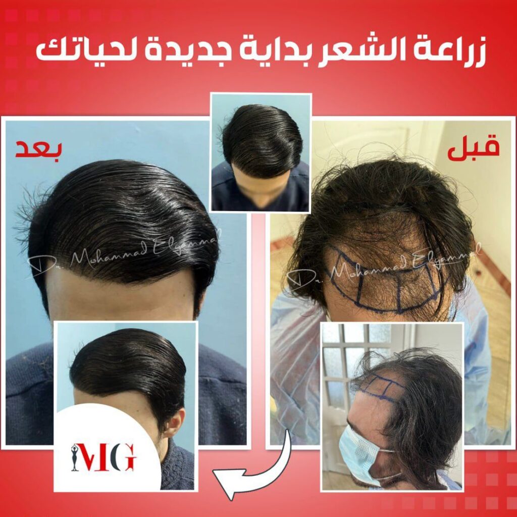 نتيجة زراعة شعر ٢ — قبل وبعد